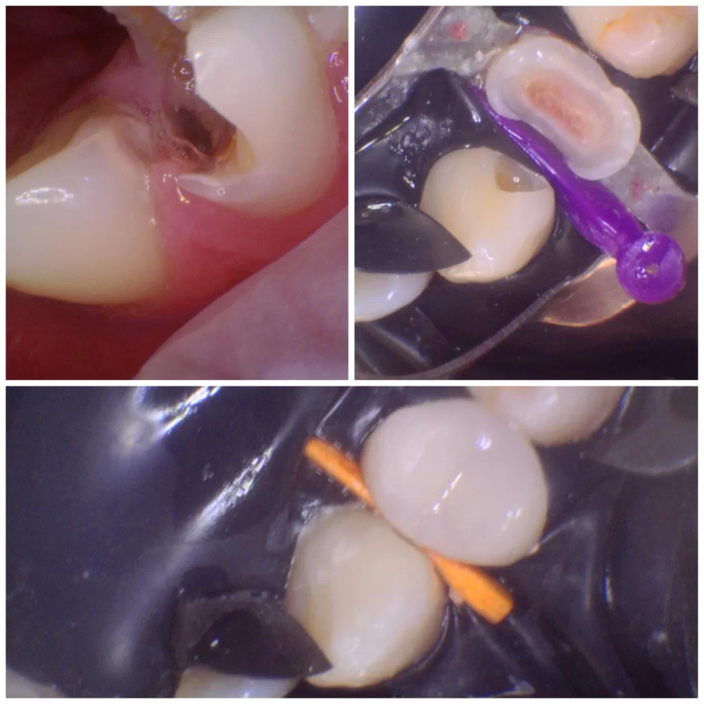 Koláž tří dentálních snímků z dentálního centra: vlevo nahoře je zkažený zub; vpravo nahoře je zobrazen stomatologický výkon zubaře s kofferdamem a fialovým nástrojem; spodní obrázek ukazuje zub s kofferdamem a vloženým oranžovým nástrojem.